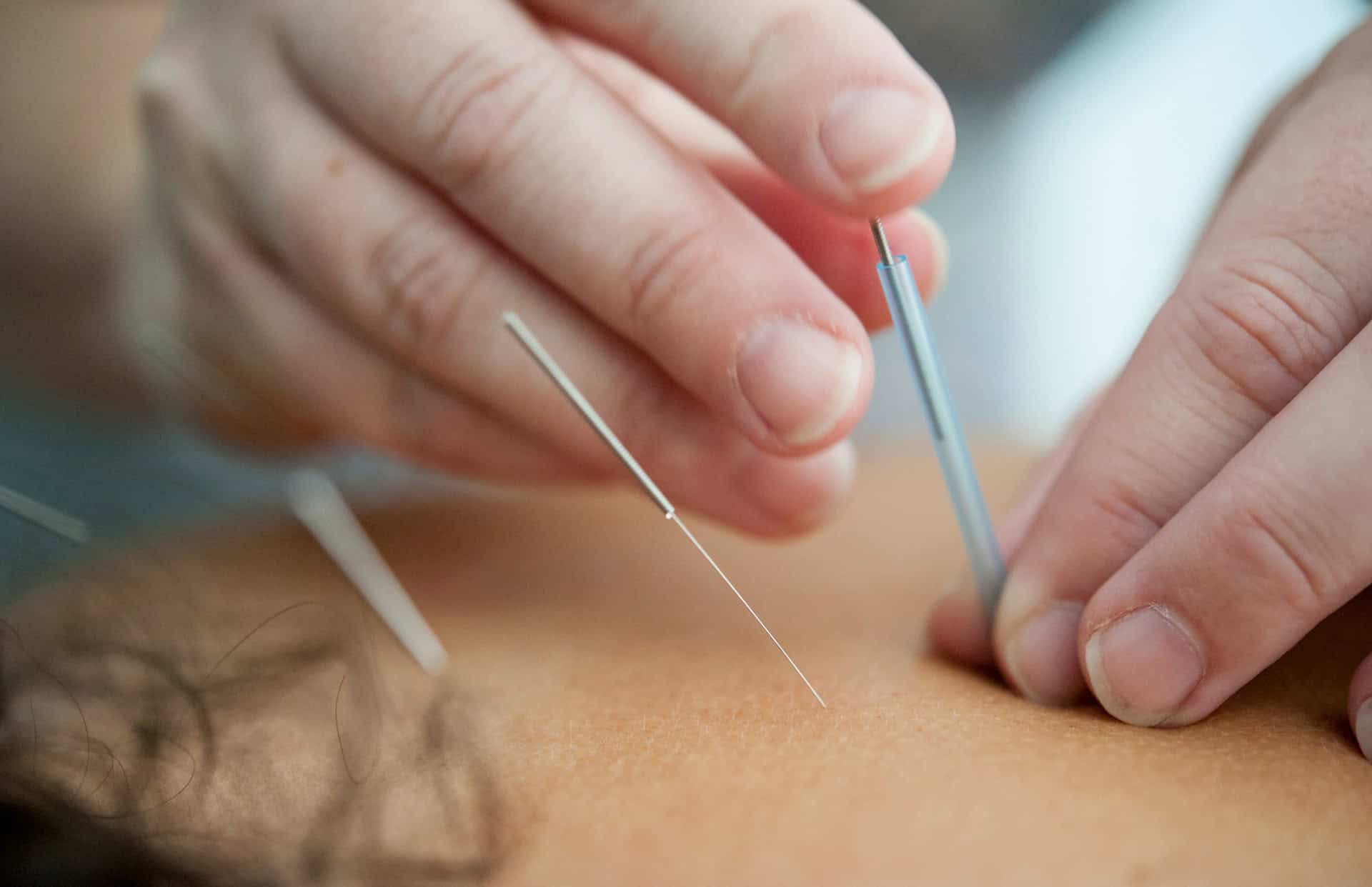 Acupuncturist in Portland, OR